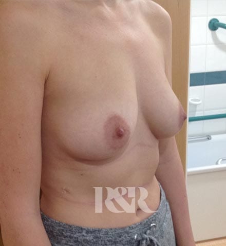 Reshape & Restore - Breast augmentation