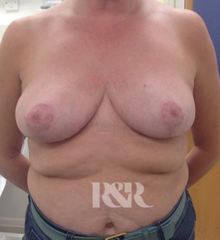 Reshape & Restore - Breast reduction