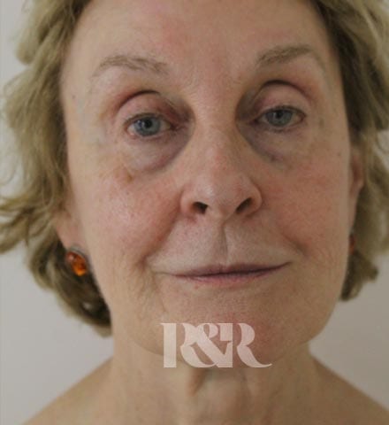 Reshape & Restore - Lower face and neck