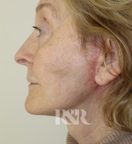 Reshape & Restore - Lower face and neck