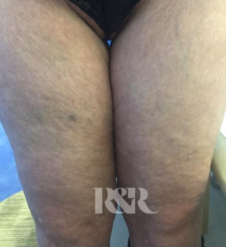 Reshape & Restore - Liposuction to thighs