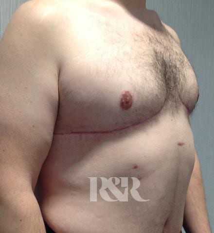 Reshape & Restore - male chest